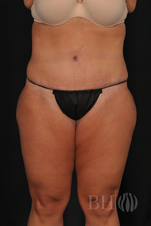 Abdominoplast With Lift Before & After